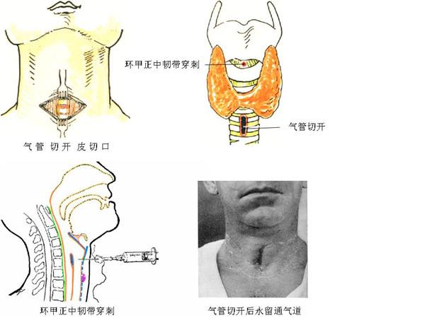 環(huán)甲膜穿刺針基本簡介